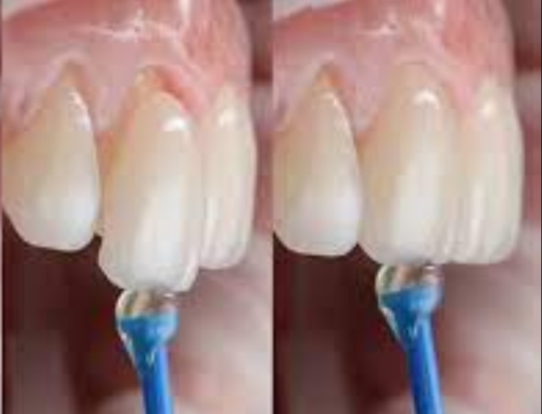 Custom veneers fit over your teeth and improve your smile.