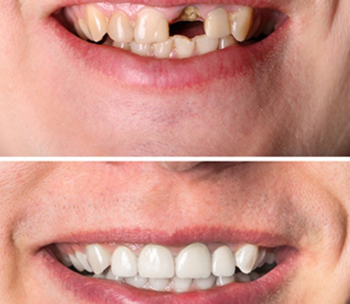 Custom veneers can replace your cracked teeth.